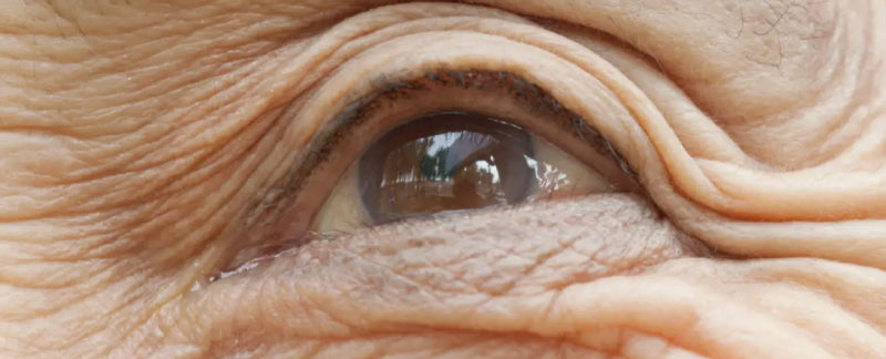 ¿Puede la fototerapia ser la clave para tratar la DMAE seca?