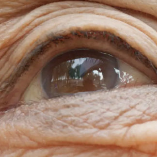 ¿Puede la fototerapia ser la clave para tratar la DMAE seca?